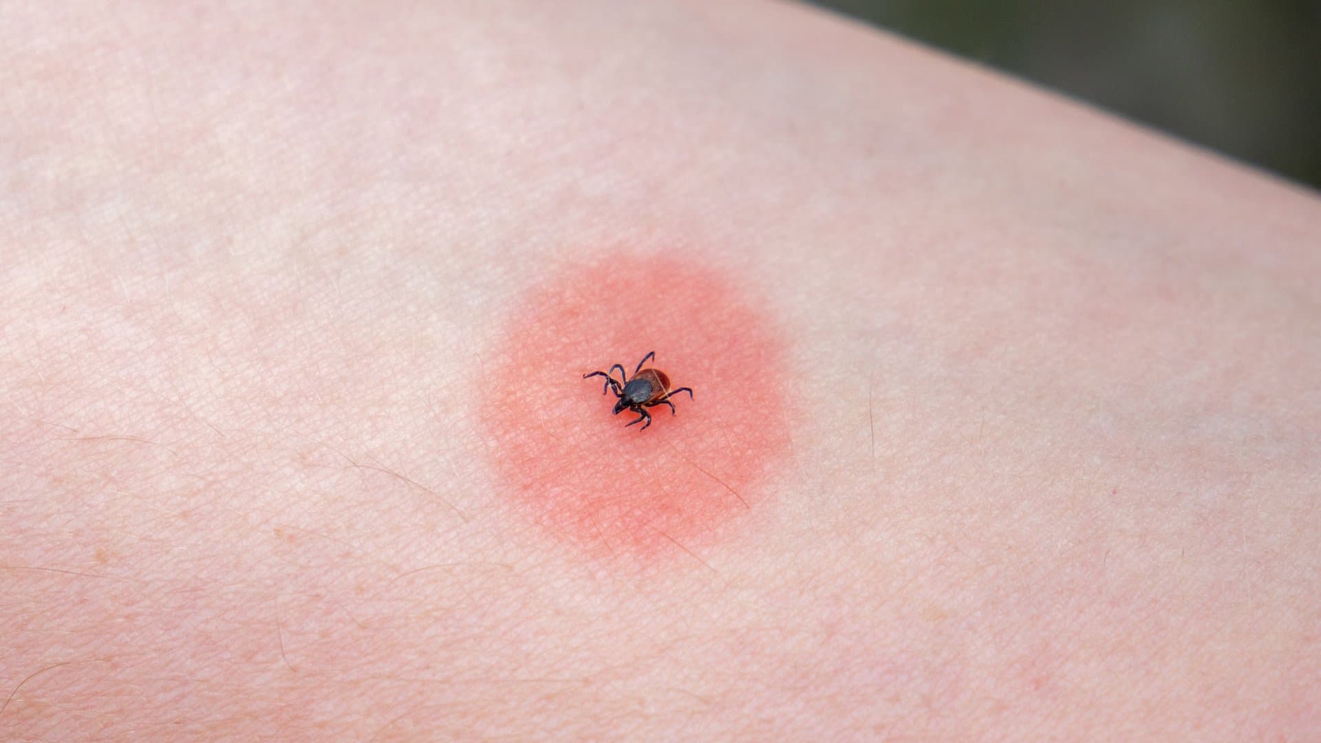 Die sogenannte Wanderröte ist ein typisches Anzeichen einer Borreliose.